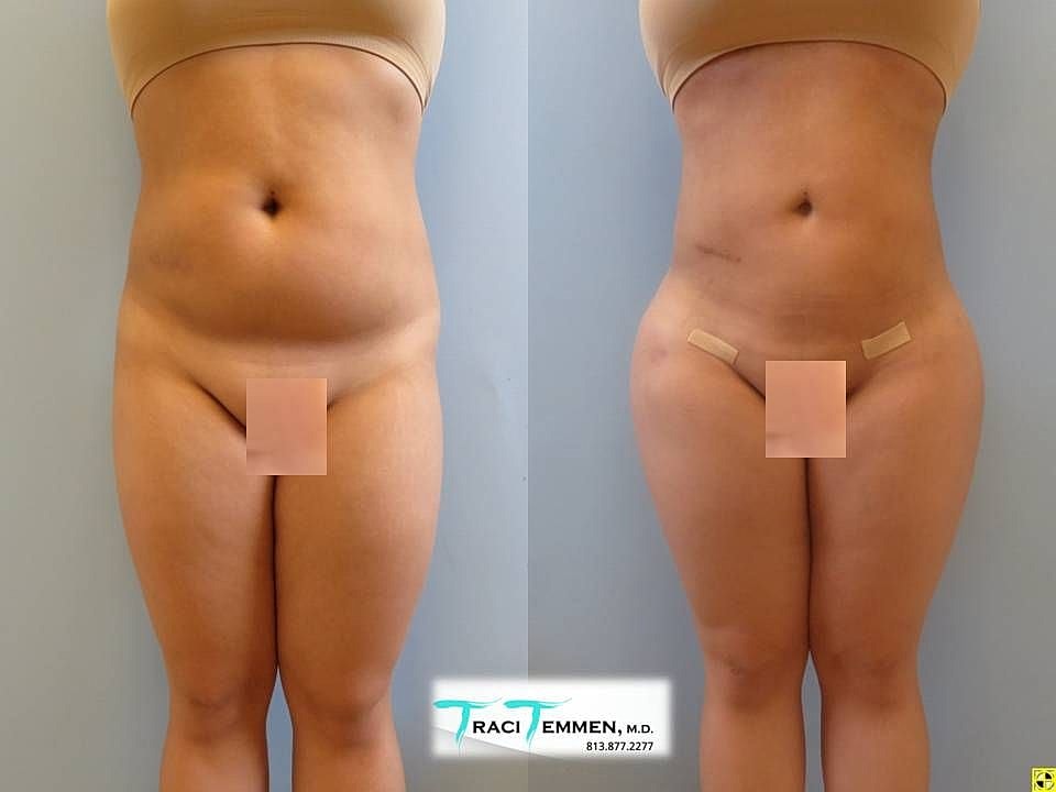 Liposuction Before & After