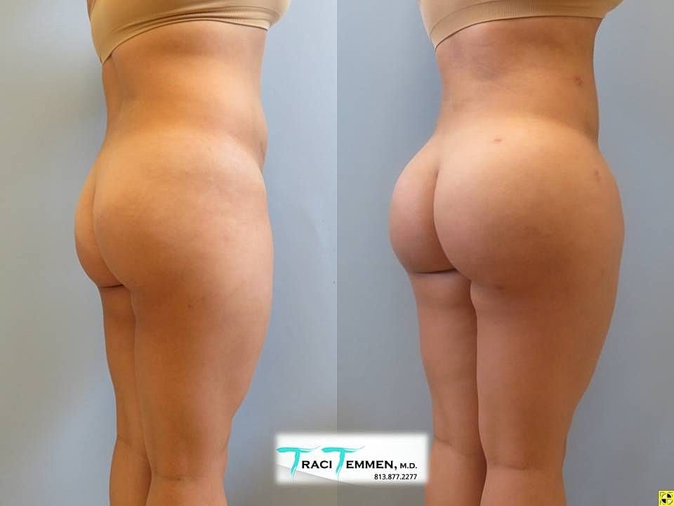 Liposuction Before & After
