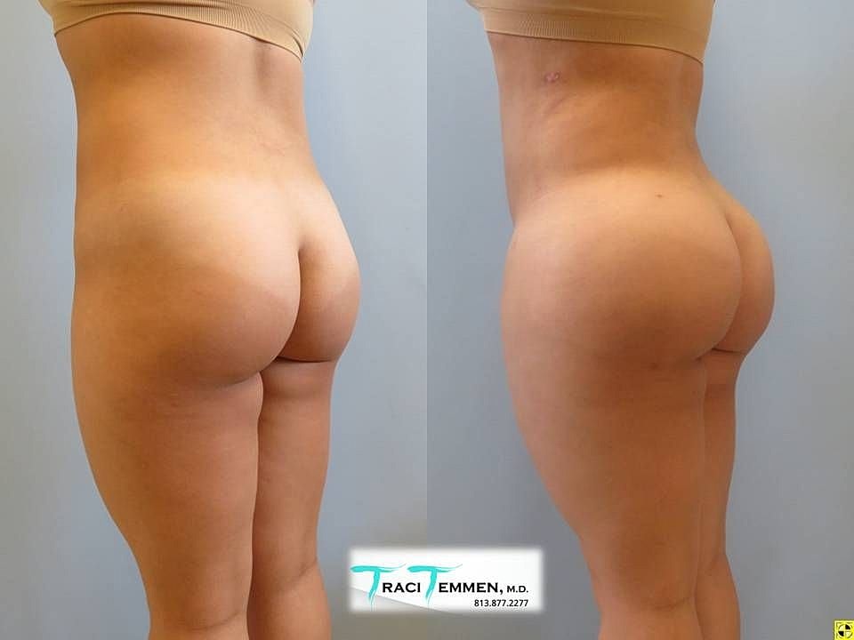 Liposuction Before & After