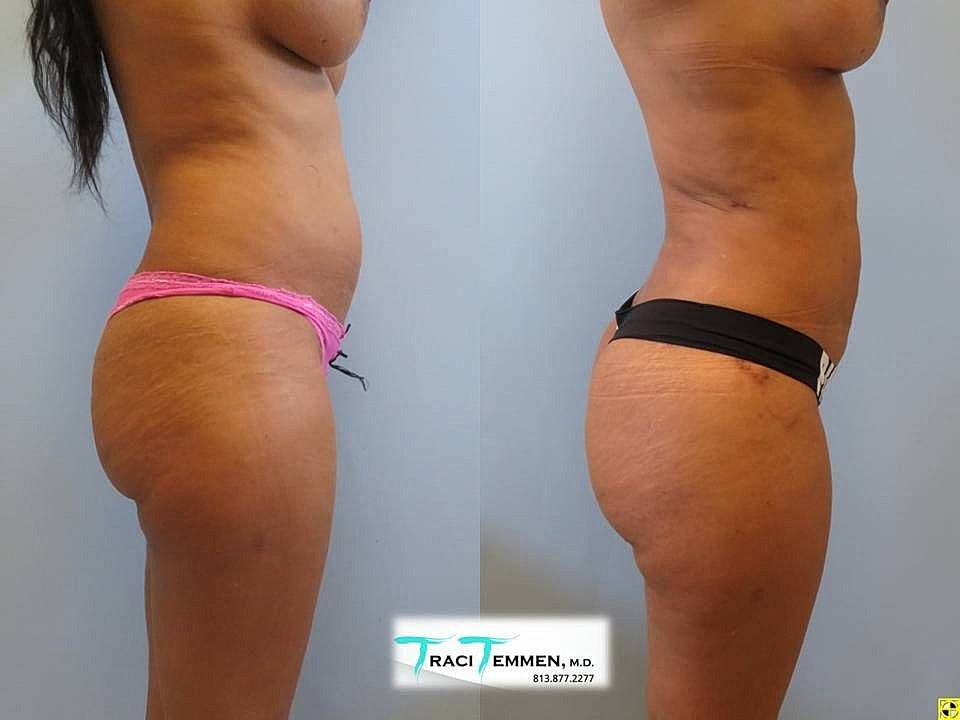 Liposuction Before & After
