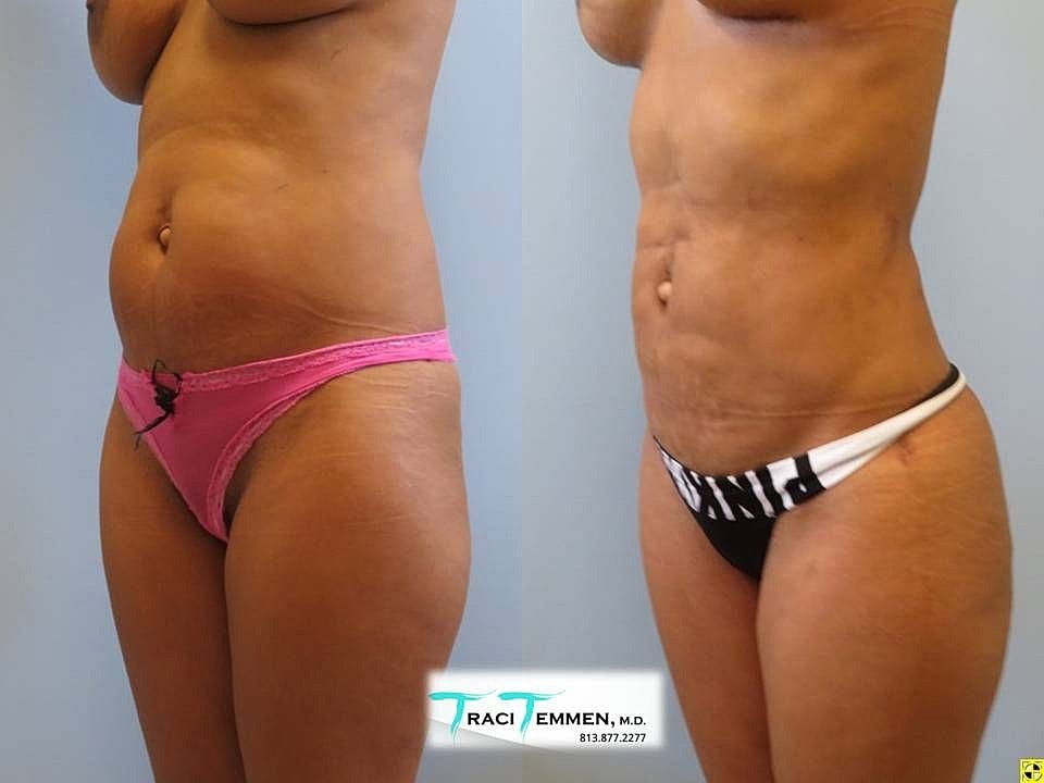 Liposuction Before & After