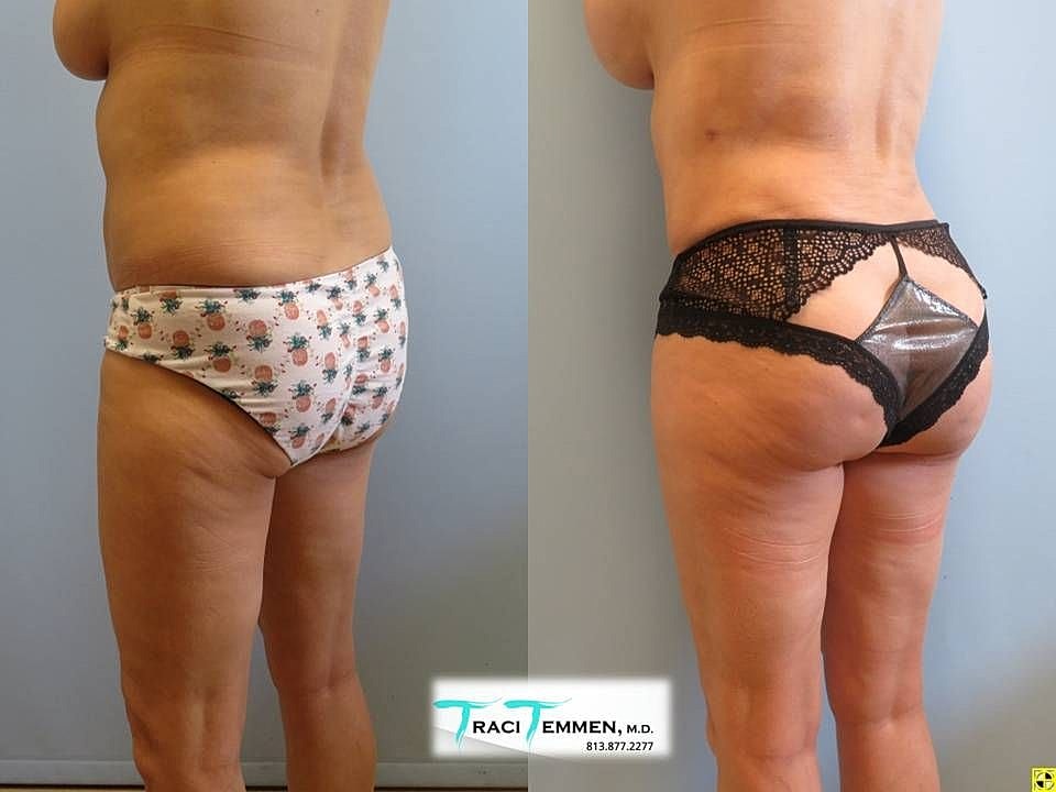 Liposuction Before & After