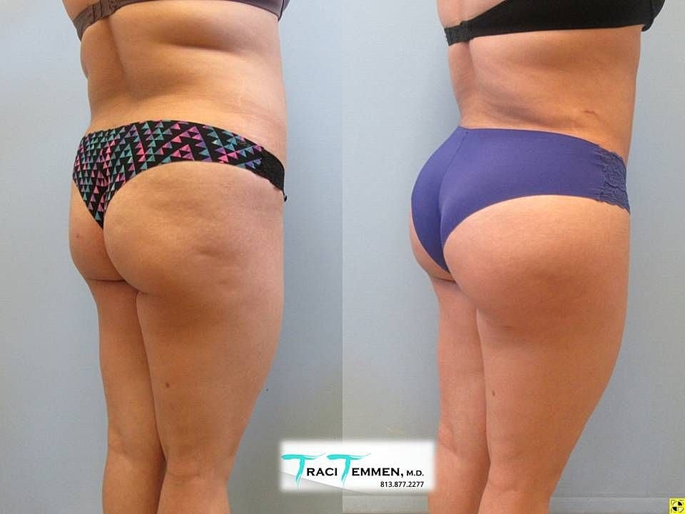 Liposuction Before & After