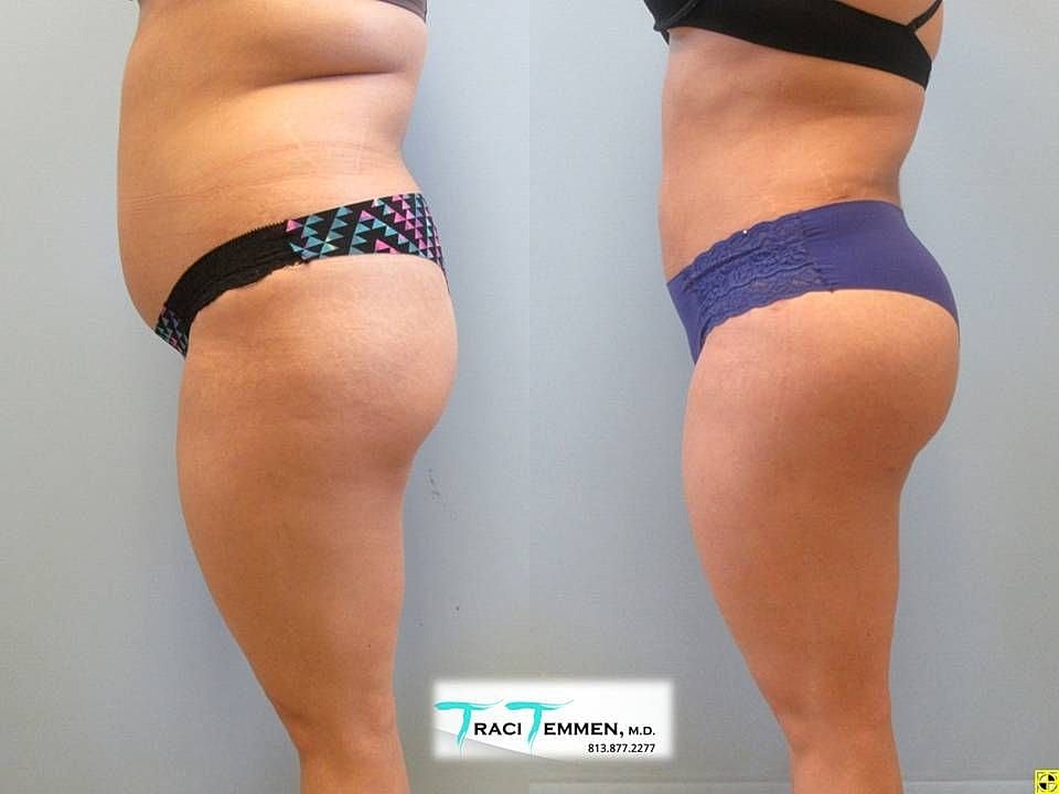 Liposuction Before & After
