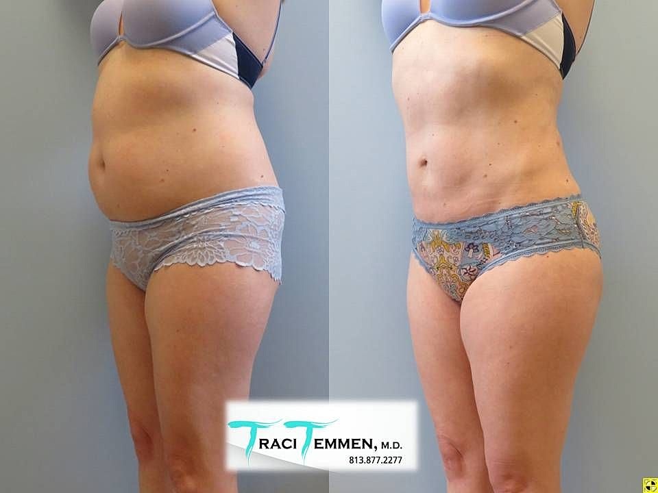 Liposuction Before & After