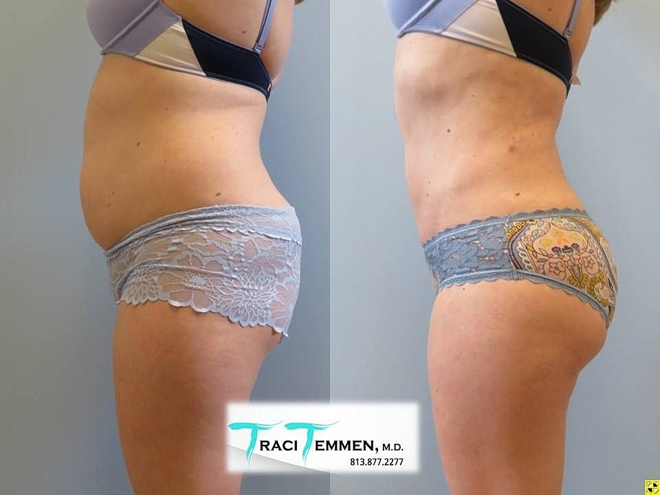 Liposuction Before & After