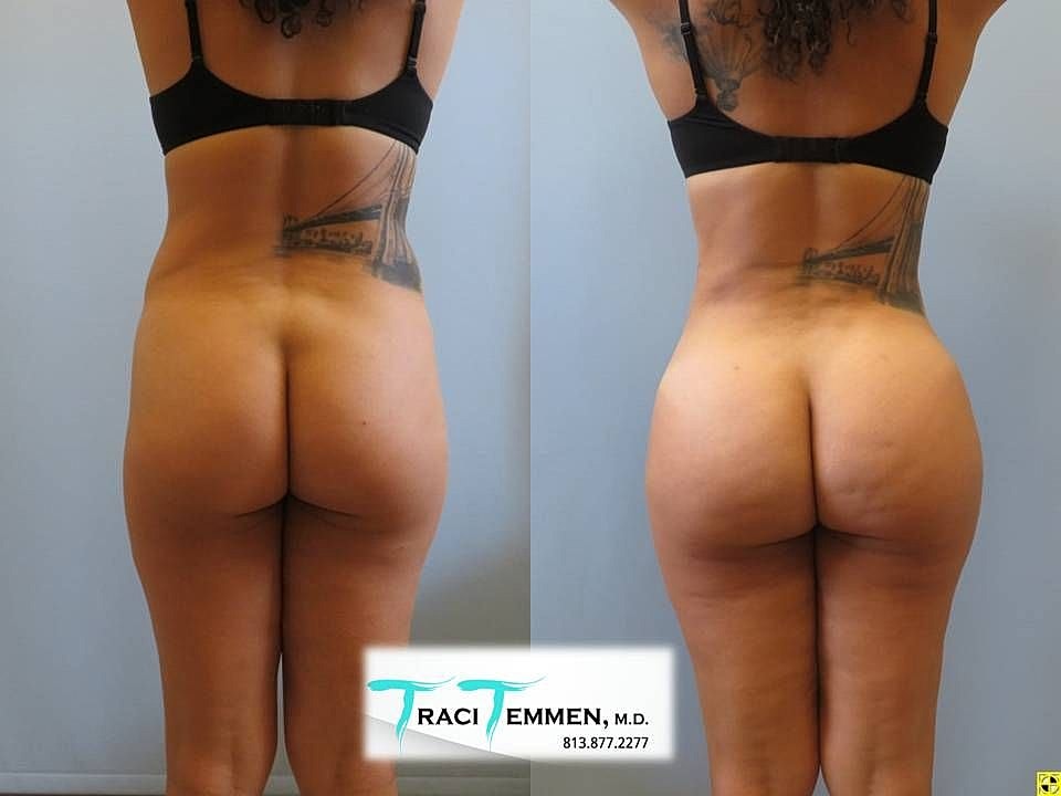 Liposuction Before & After