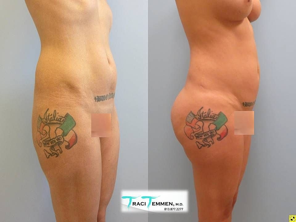 Liposuction Before & After