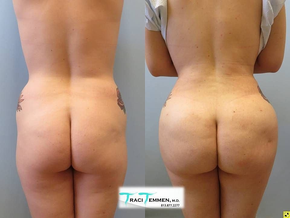 Liposuction Before & After