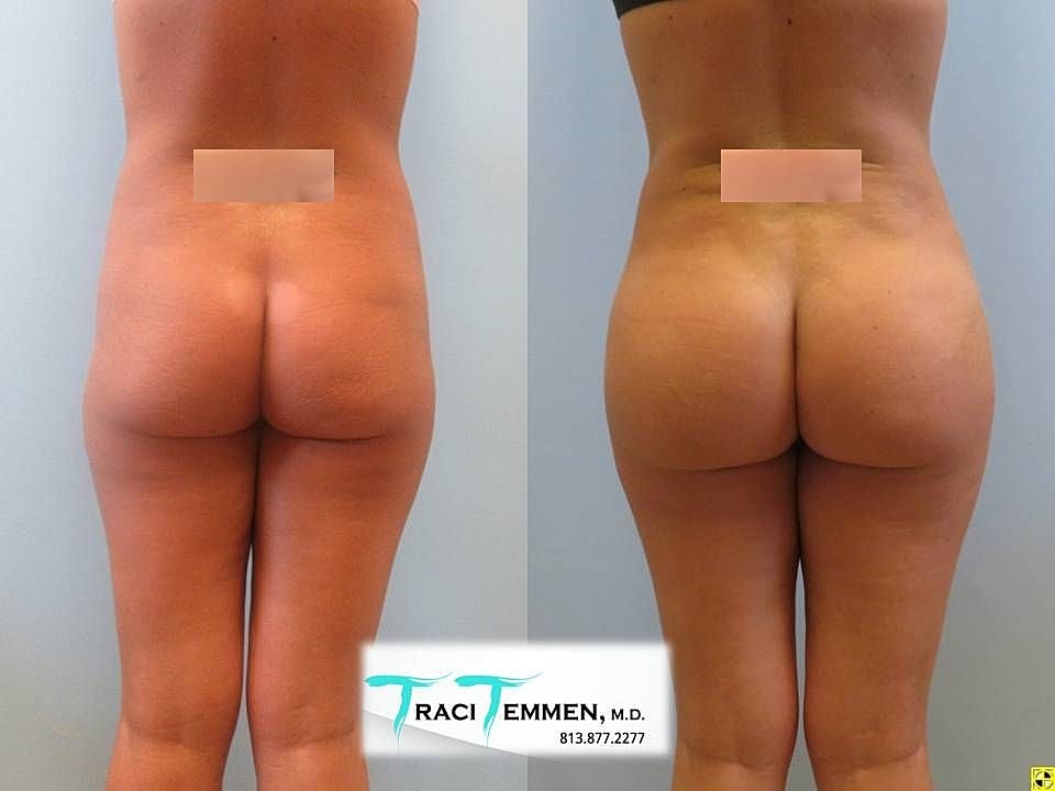 Liposuction Before & After