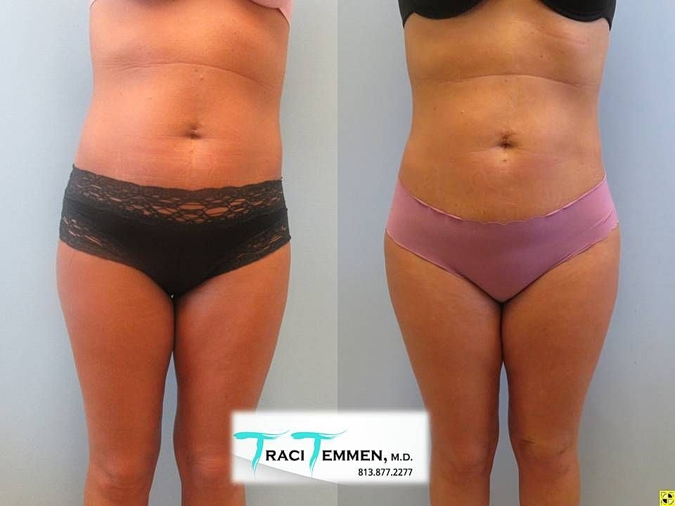 Liposuction Before & After
