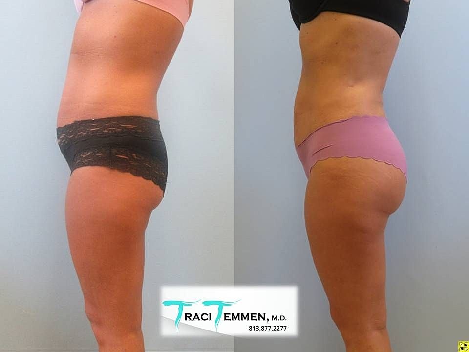 Liposuction Before & After