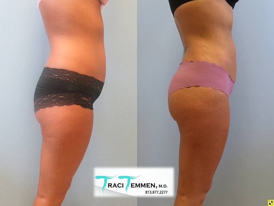 Liposuction Before & After