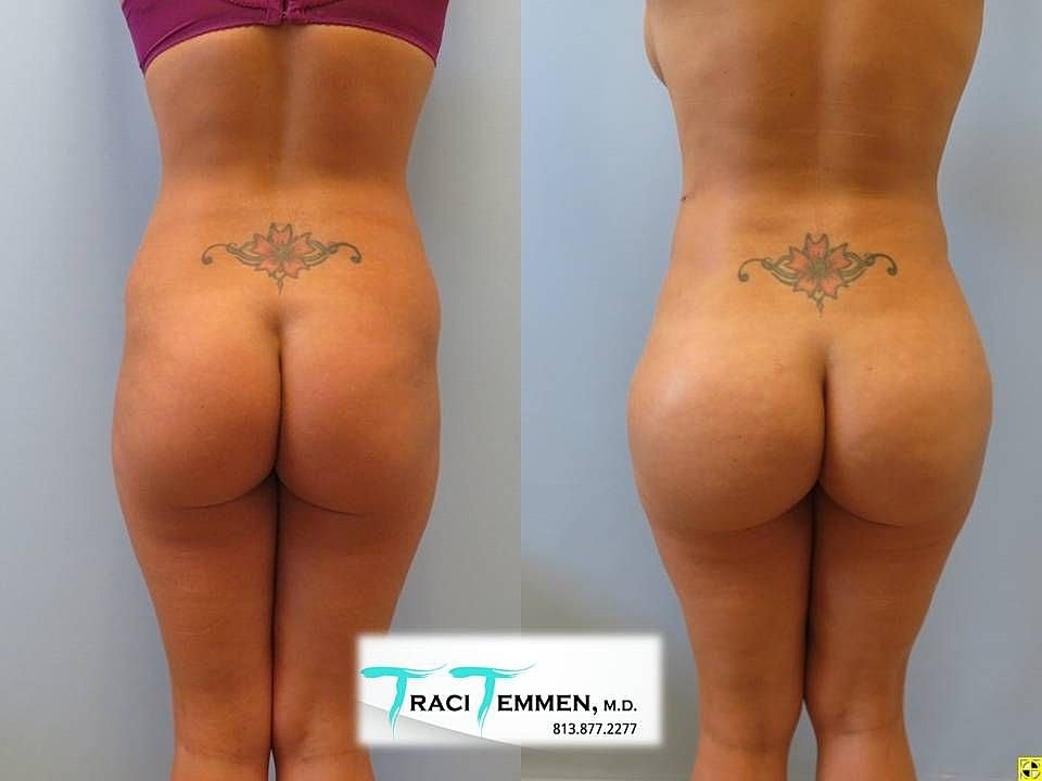 Liposuction Before & After
