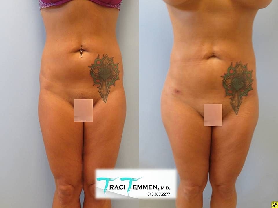 Liposuction Before & After