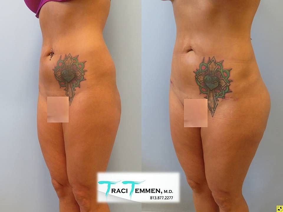 Liposuction Before & After