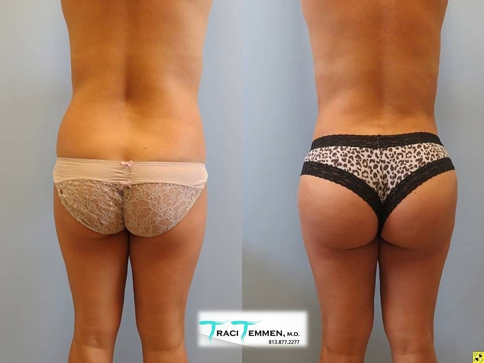 Liposuction Before & After