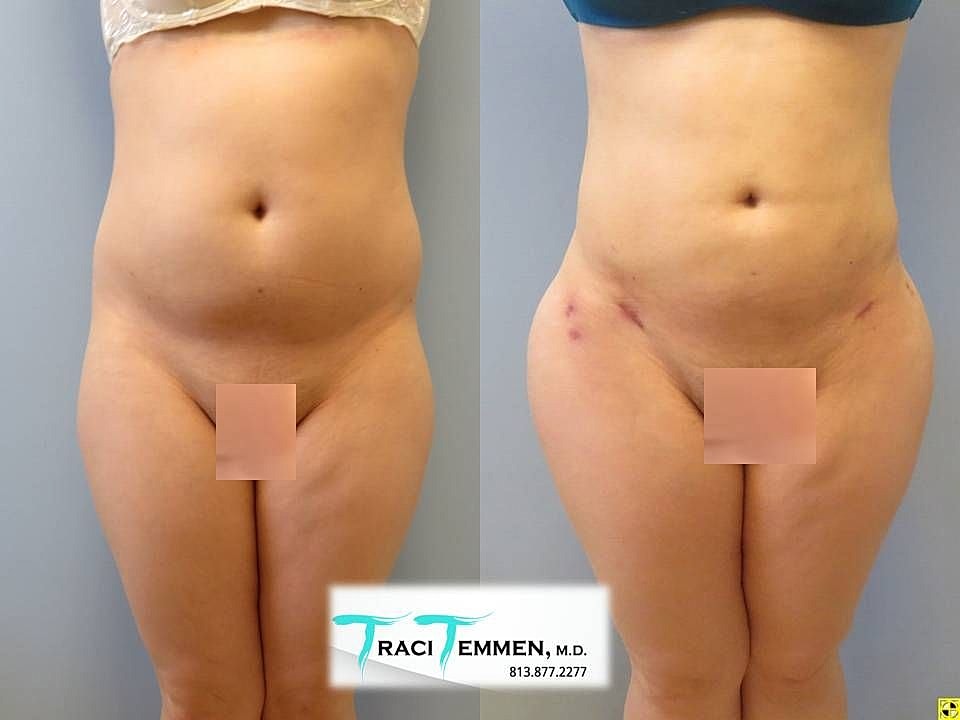 Liposuction Before & After