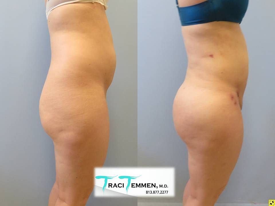Liposuction Before & After