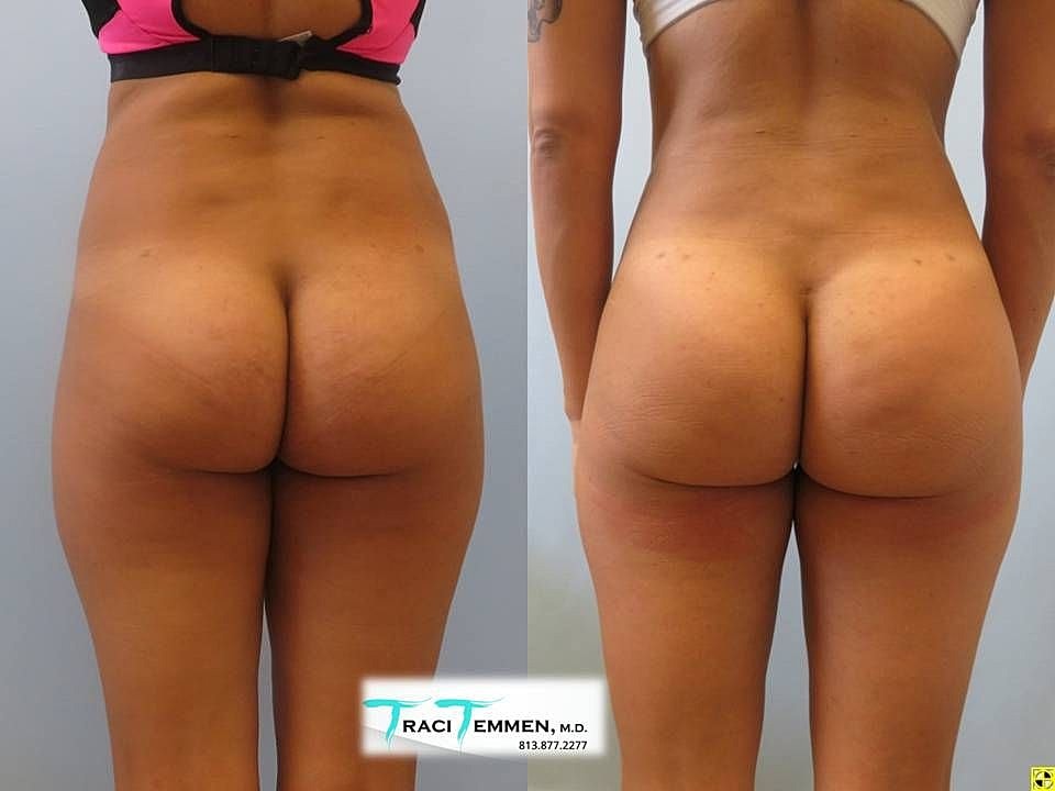 Liposuction Before & After