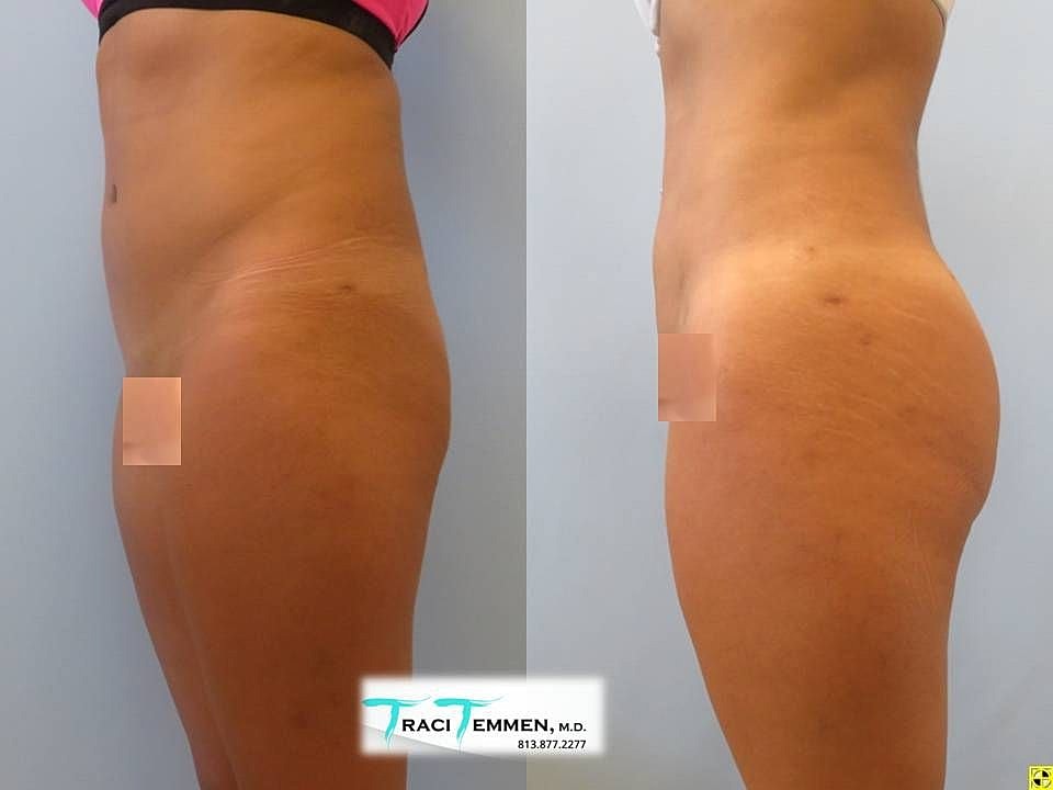 Liposuction Before & After
