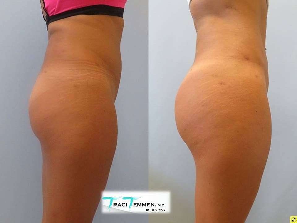 Liposuction Before & After
