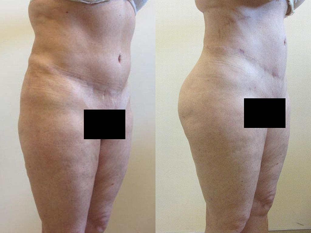 Liposuction Before & After