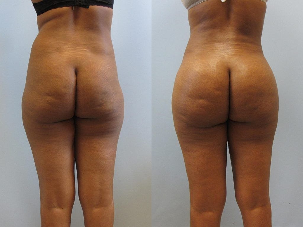 Liposuction Before & After