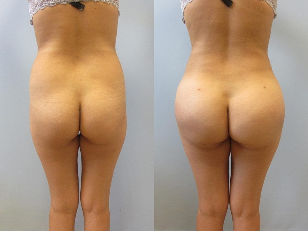 Liposuction Before & After