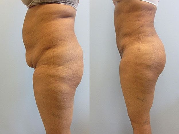 Liposuction Before & After