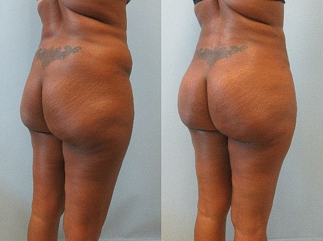 Liposuction Before & After
