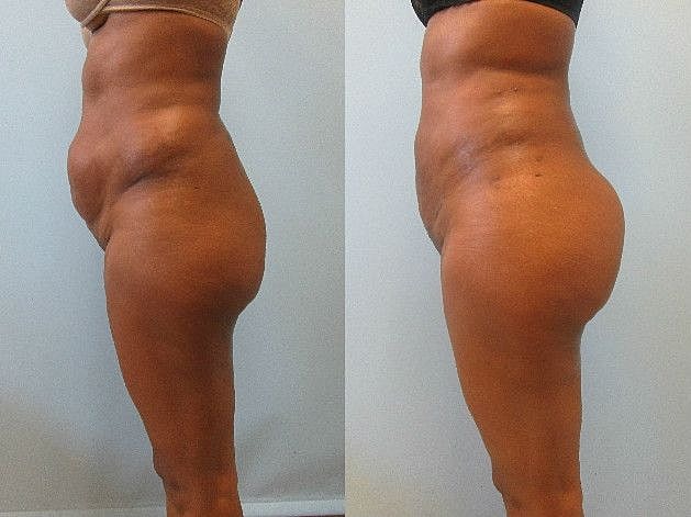 Liposuction Before & After