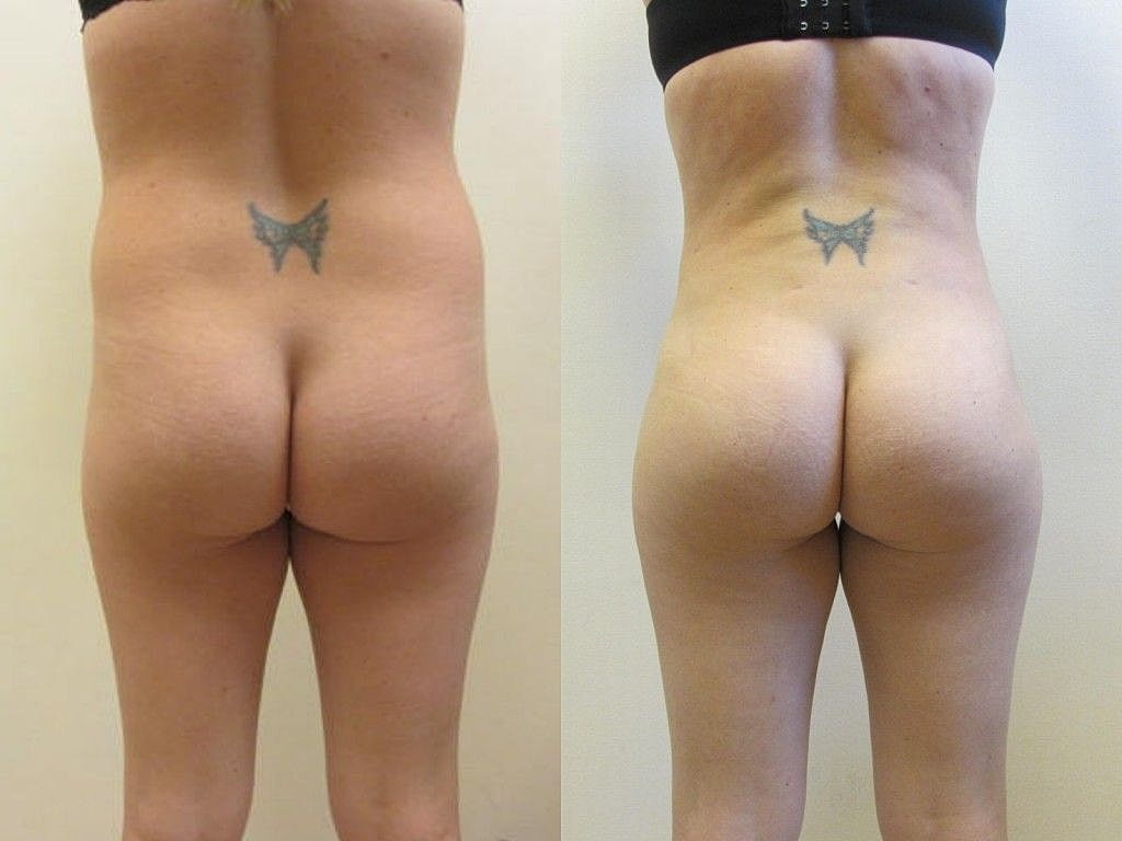 Liposuction Before & After