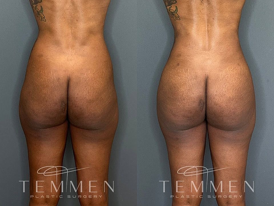 Liposuction Before & After