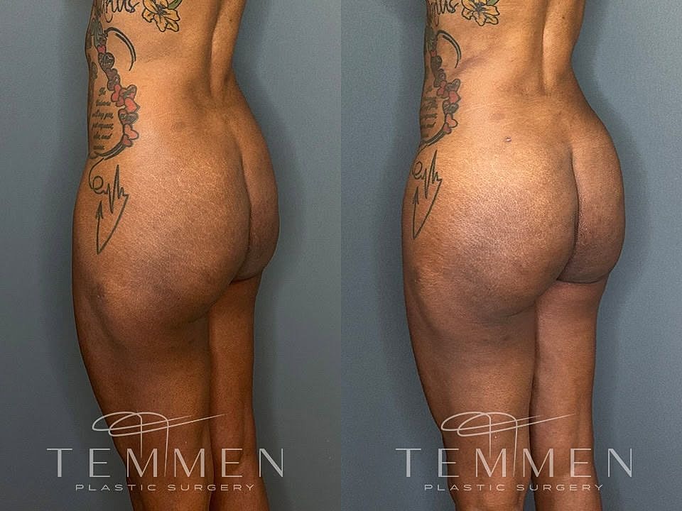 Liposuction Before & After