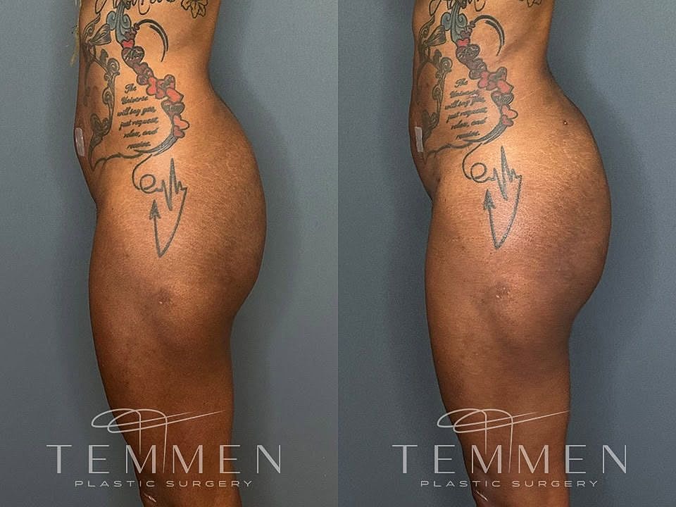 Liposuction Before & After