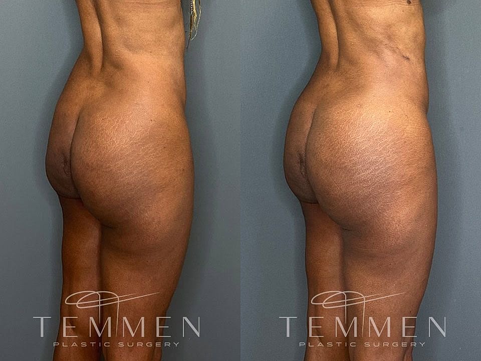 Liposuction Before & After