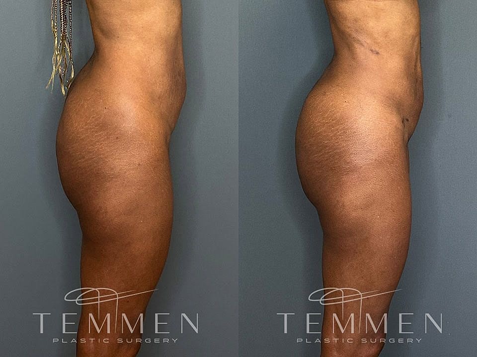 Liposuction Before & After