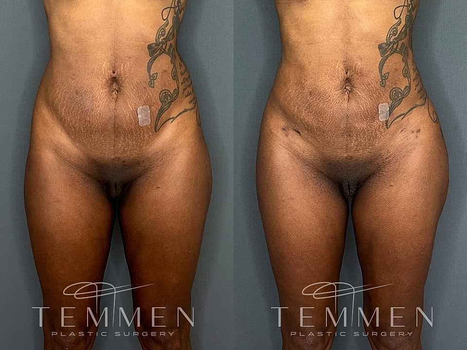 Liposuction Before & After