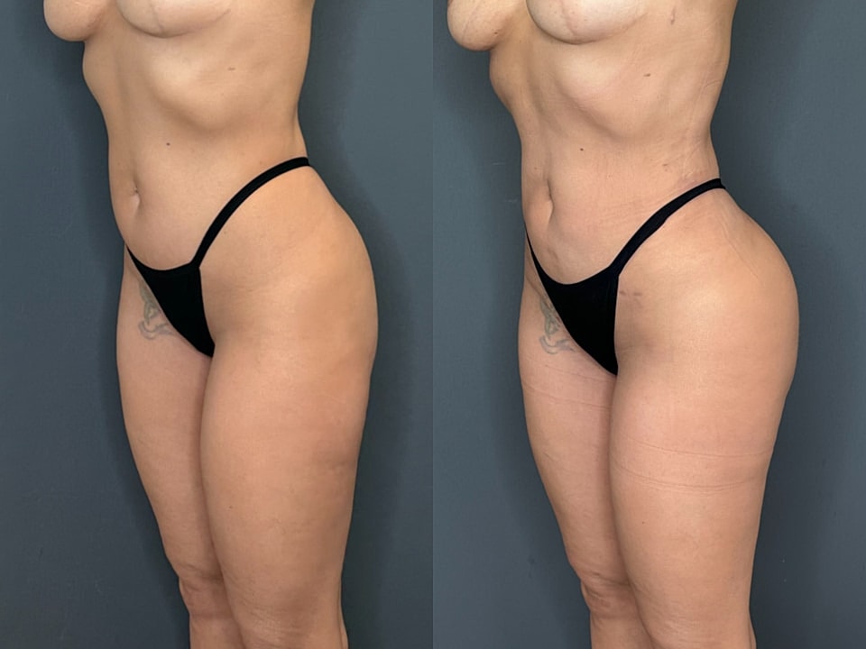 Liposuction Before & After