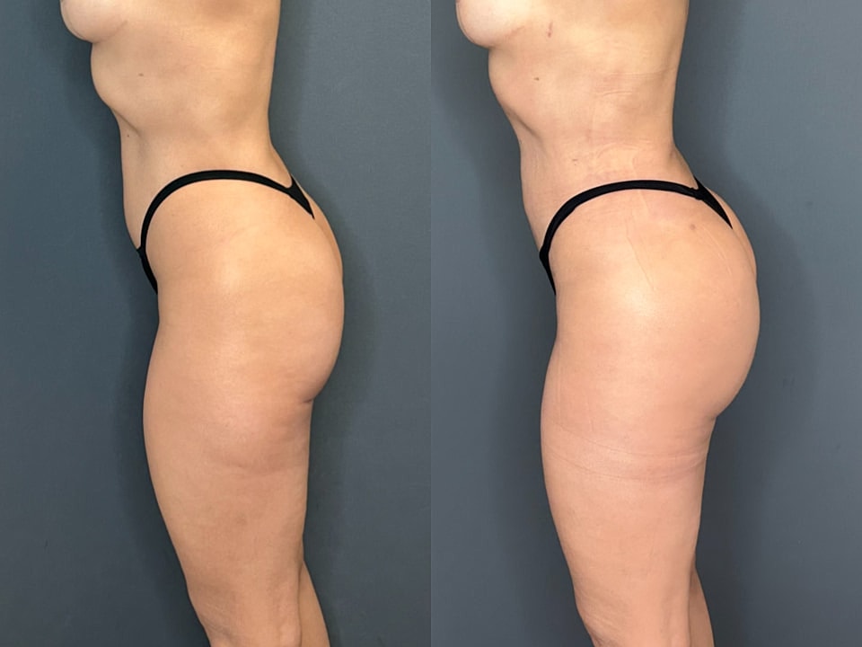 Liposuction Before & After
