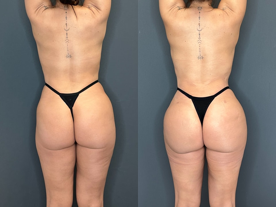 Liposuction Before & After