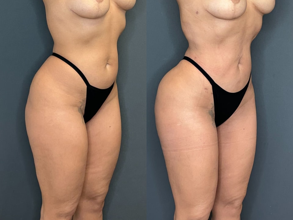Liposuction Before & After