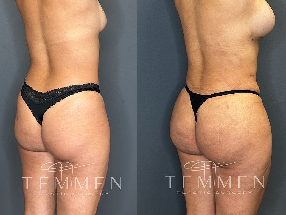Liposuction Before & After