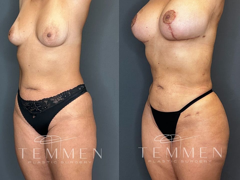 Liposuction Before & After