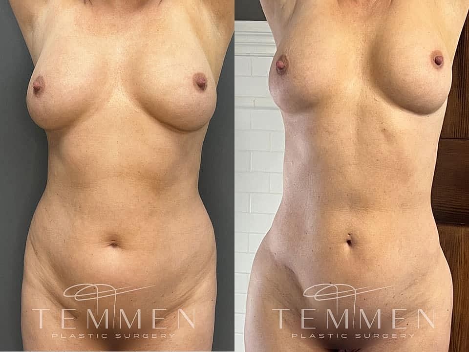 Liposuction Before & After
