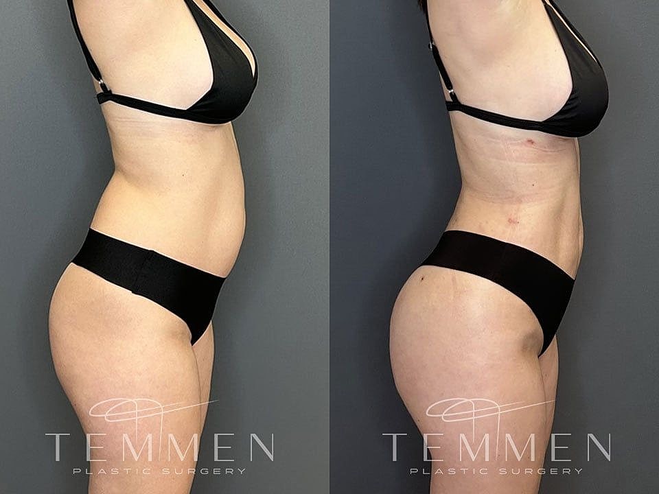 Liposuction Before & After