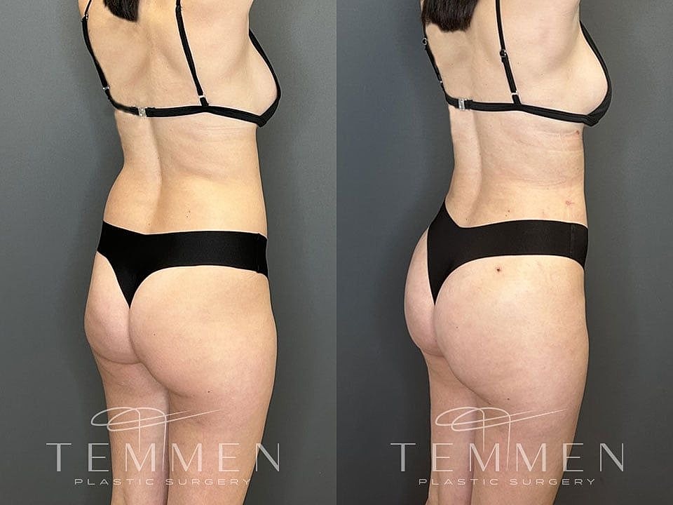 Liposuction Before & After