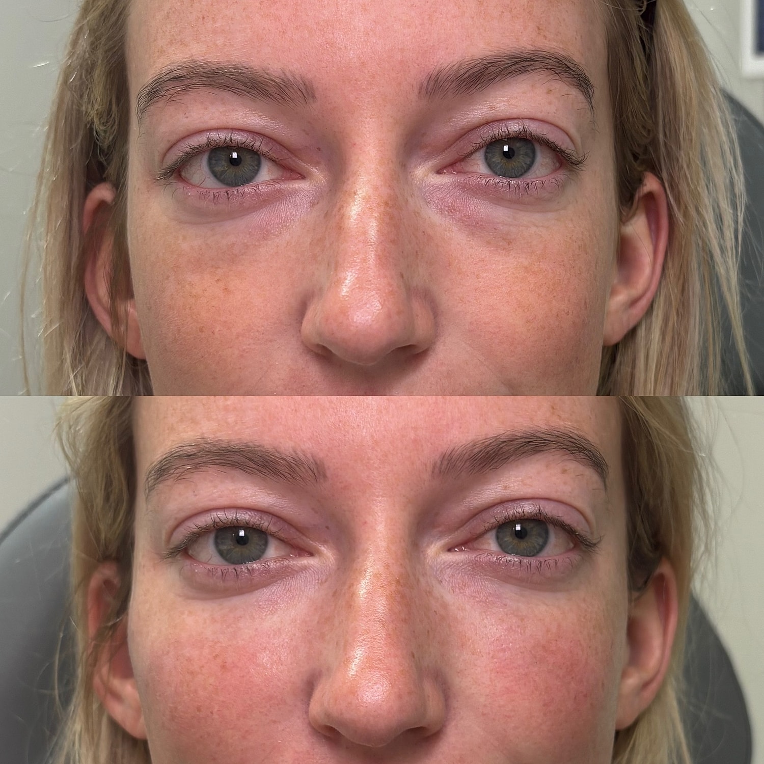 Cheek Filler Before & After