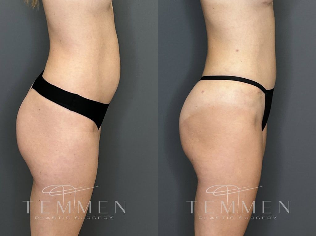 Tummy Tuck Before & After